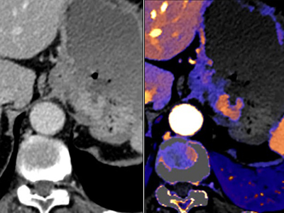 TDM classique vs TDM &agrave; d&eacute;tection spectrale