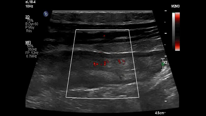 comparatif de la maladie de Crohn et de la rectocolite h&eacute;morragique