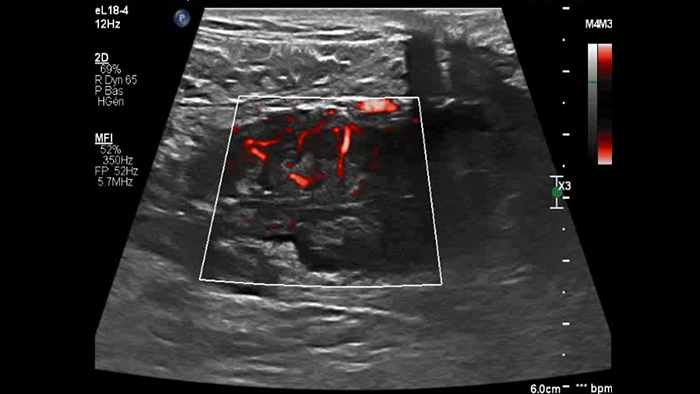 comparatif de la maladie de Crohn et de la rectocolite h&eacute;morragique