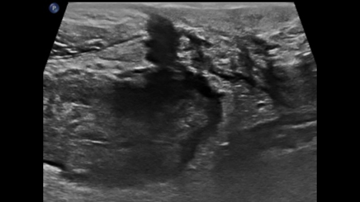 comparatif de la maladie de Crohn et de la rectocolite h&eacute;morragique