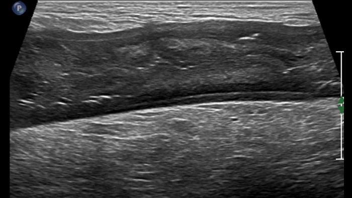 comparatif de la maladie de Crohn et de la rectocolite h&eacute;morragique