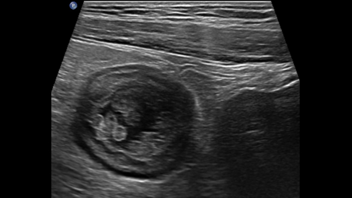 comparatif de la maladie de Crohn et de la rectocolite h&eacute;morragique