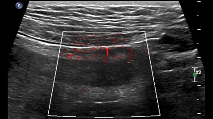 comparatif de la maladie de Crohn et de la rectocolite h&eacute;morragique