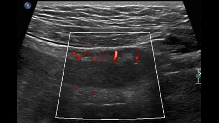 comparatif de la maladie de Crohn et de la rectocolite h&eacute;morragique