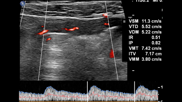 comparatif de la maladie de Crohn et de la rectocolite h&eacute;morragique