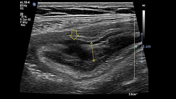 Crohn&rsquo;s disease wall