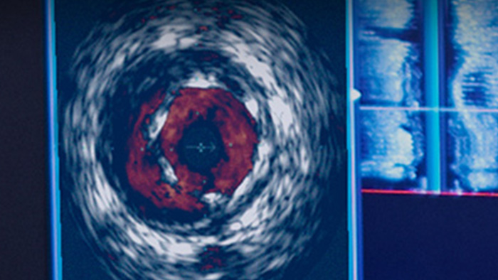 Imagerie &eacute;chographique ChromaFlo