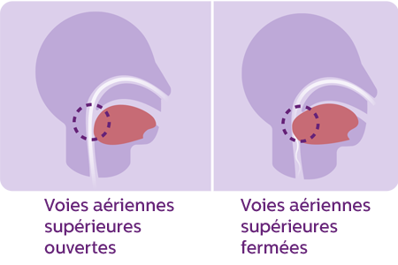 'Illustration de l'obstruction des voies a&eacute;riennes sup&eacute;rieures en cas d'apn&eacute;e du sommeil