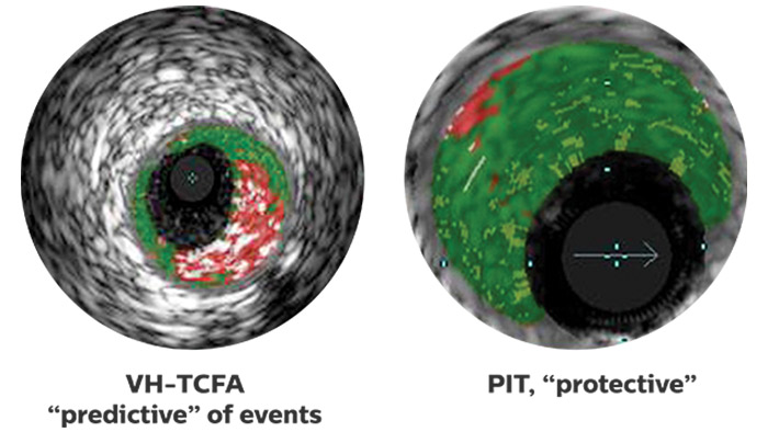 Applications cliniques &eacute;chographie intravasculaire vh