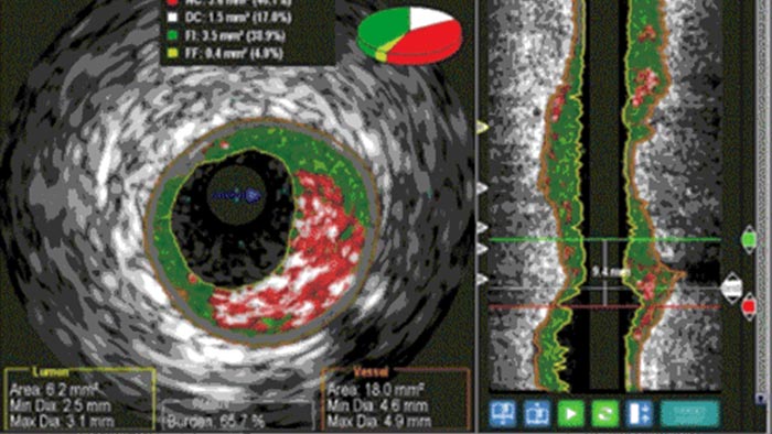 &Eacute;chographie intravasculaire vh contourage auto