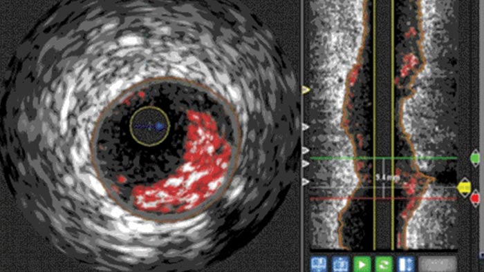 &Eacute;chographie intravasculaire vh mesure lumi&egrave;re vaisseaux