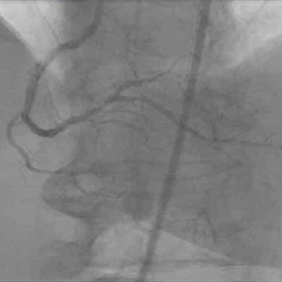 St&eacute;nose ostiale