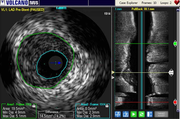 Affichage de l&rsquo;&eacute;chographie intravasculaire
