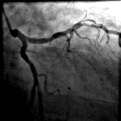 Angiographie ambigu&euml;