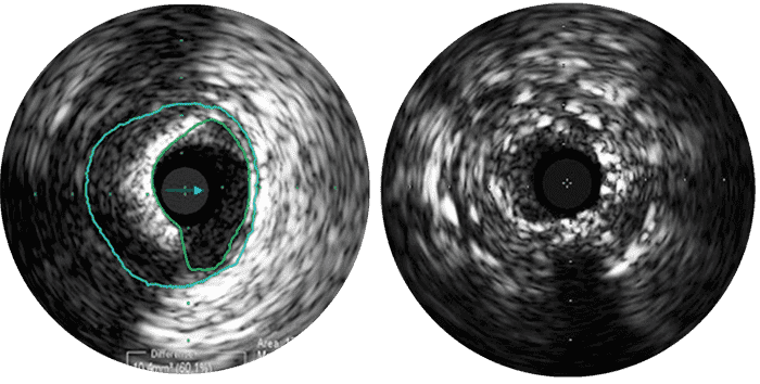 Patients r&eacute;cidivants