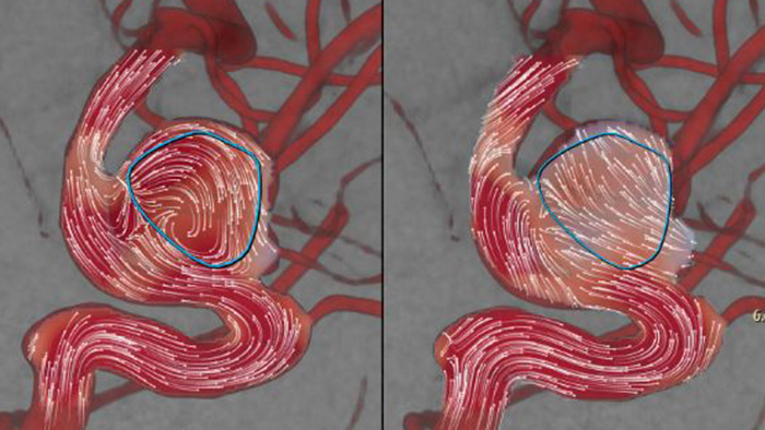 D&eacute;ploiement d&rsquo;un d&eacute;viateur de flux sanguin AneurysmFlow