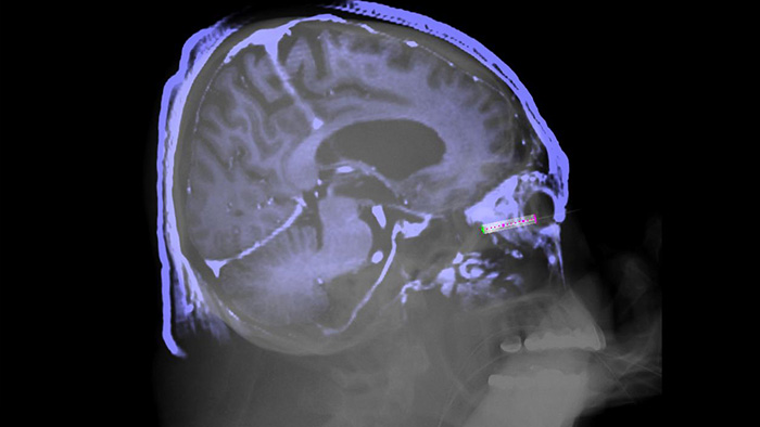 Guidage de l&rsquo;aiguille en&nbsp;3D XperGuide