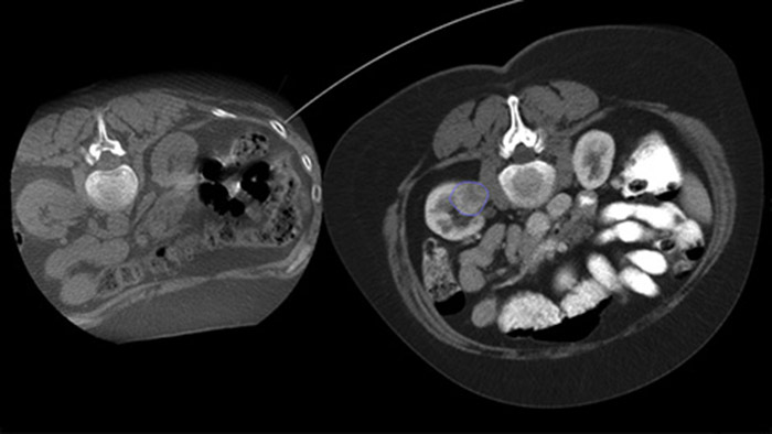 Imagerie des l&eacute;sions apr&egrave;s ablation avec CBCT