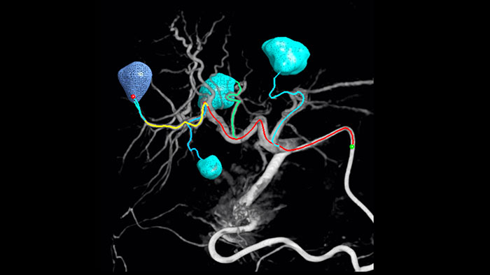 D&eacute;tection automatique des vaisseaux nourriciers avec EmboGuide