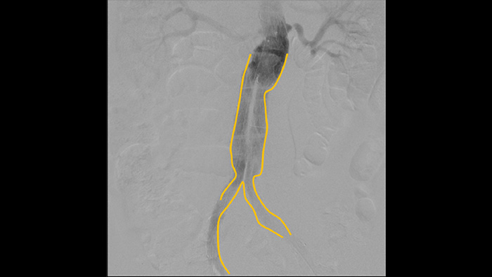 Outil de contour pour le marquage des bifurcations ou des branches lat&eacute;rales
