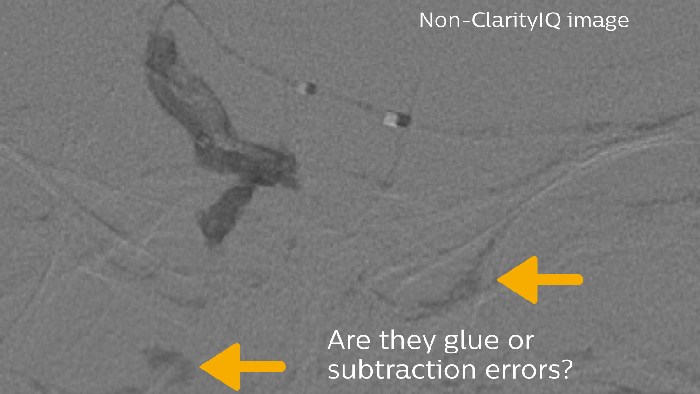 Erreur de collage et de soustraction