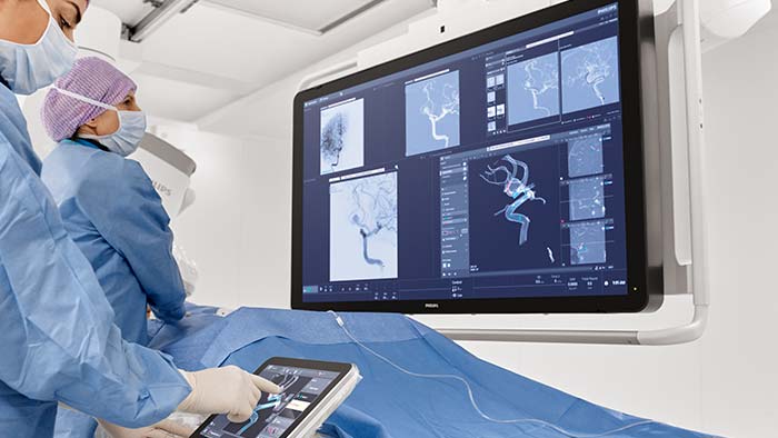 Traitement de l’anévrisme cérébral