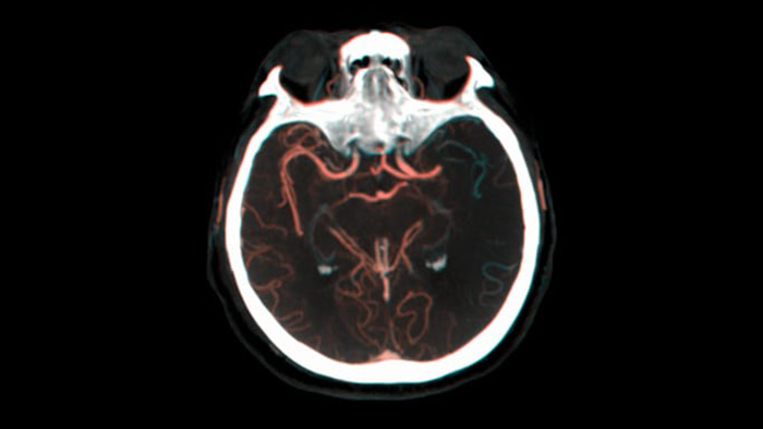 Visualisation du remplissage des collat&eacute;rales
