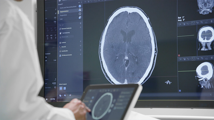 Traitement d’un accident vasculaire cérébral ischémique