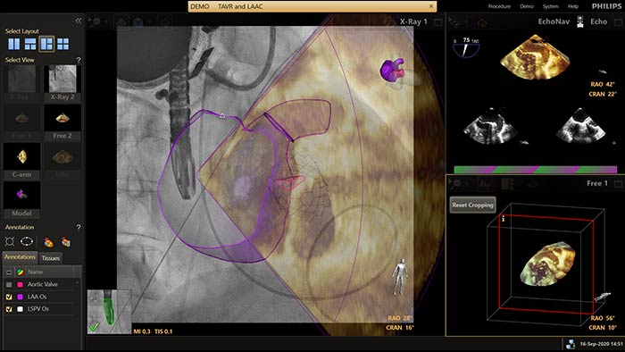 EchoNavigator - Occlusion de l&rsquo;appendice auriculaire gauche