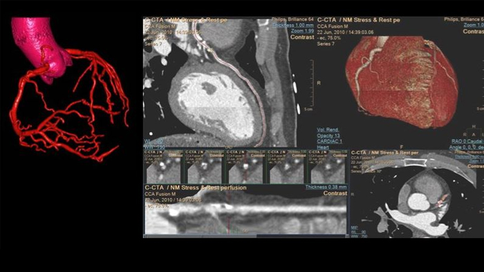 IntelliSpace Portal&nbsp;: IA avec des mod&egrave;les&nbsp;3D