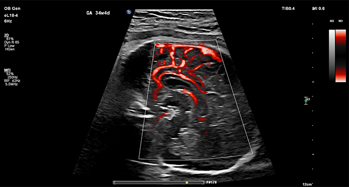 Intestin f&oelig;tal avec comparaison MicroFlow Imaging