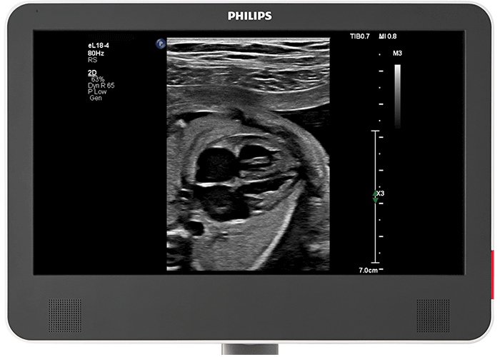 &Eacute;chographie f&oelig;tale