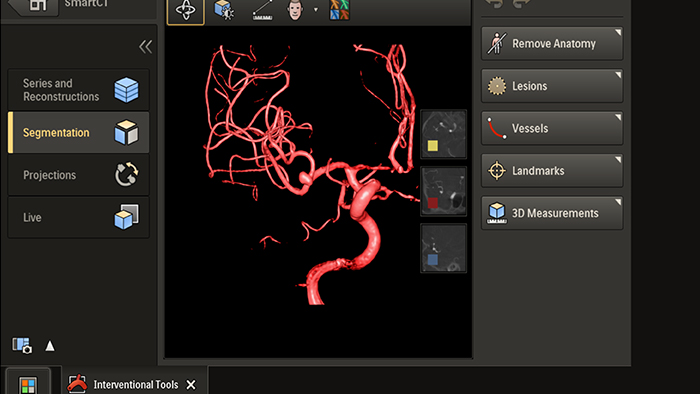 TMS Azurion Acquisition 3D &agrave; port&eacute;e de main procedure interventionnelle avec Smart CT