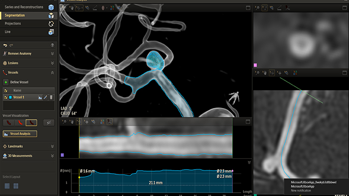 Acquisition images 3Dhaute resolution HD de type scanner pour procedures interventionnelles smartCT