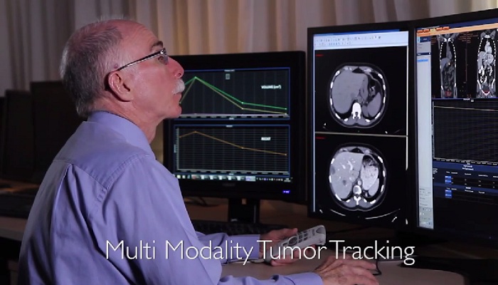 &Eacute;valuation du traitement gr&acirc;ce &agrave; la quantification : application Multi Modality Tumor Tracking sur IntelliSpace Portal