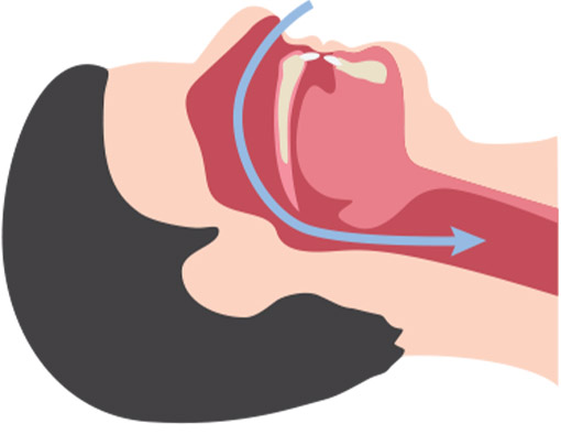 Voies a&eacute;riennes non obstru&eacute;es