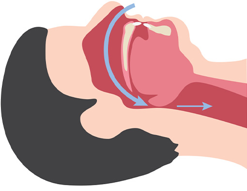 Voies a&eacute;riennes obstru&eacute;es
