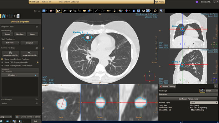 D&eacute;tection et caract&eacute;risation des nodules pulmonaires bas&eacute;s sur l'IA