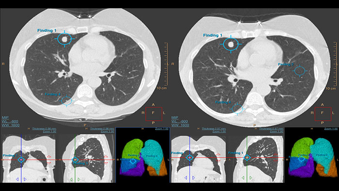 Vignette de l&rsquo;&eacute;valuation d&rsquo;un nodule pulmonaire