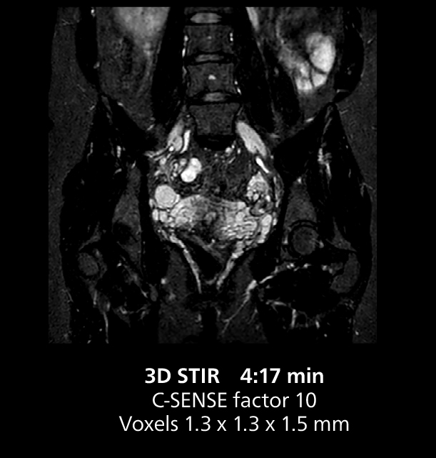 Irm du pelvis trois