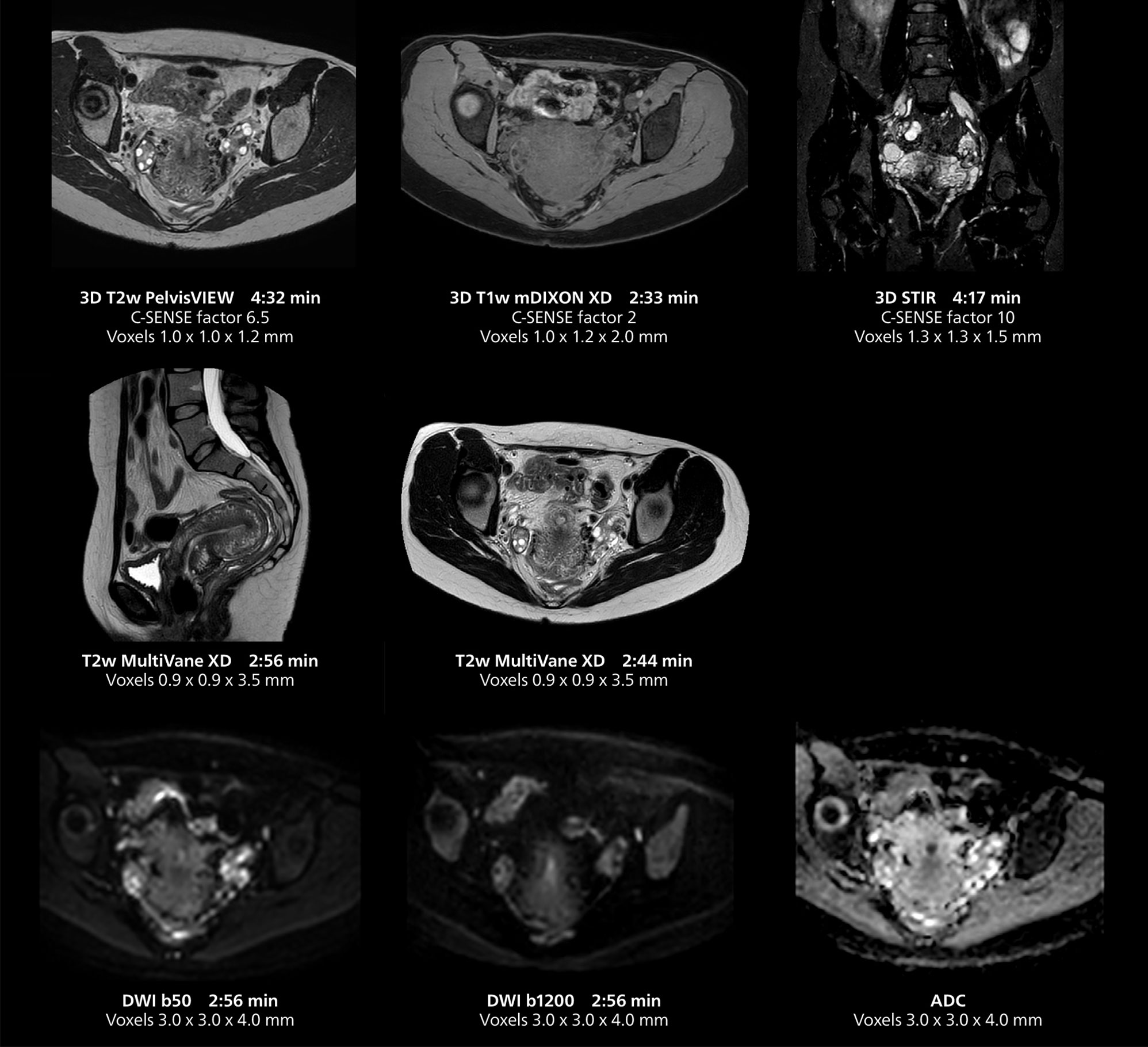 Irm du pelvis f&eacute;minin