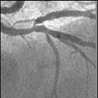 L&eacute;sions de bifurcation