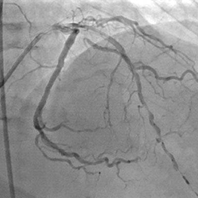 L&eacute;sions diffuses &eacute;tendues