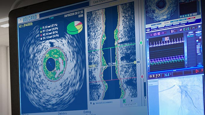 &Eacute;chographie intravasculaire VH