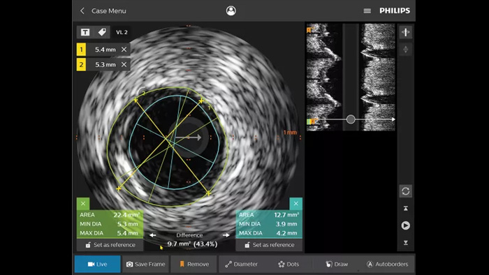 IntraSight fournit plus d'informations gr&acirc;ce aux modalit&eacute;s iFR/FFR et IVUS