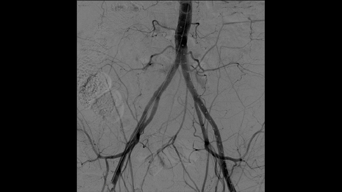 Traitement des images vasculaires