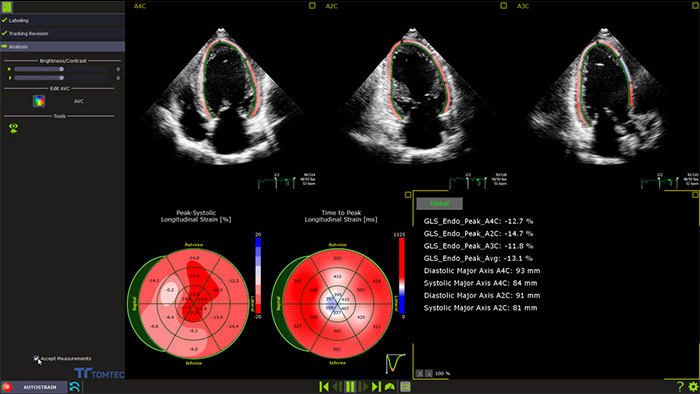 Strain&nbsp;sur le VG: exemple de la cardio-oncologie avec le Dr Ederhy et le Pr Cohen