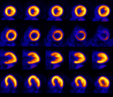 Examen d&rsquo;imagerie TEP analogique du c&oelig;ur
