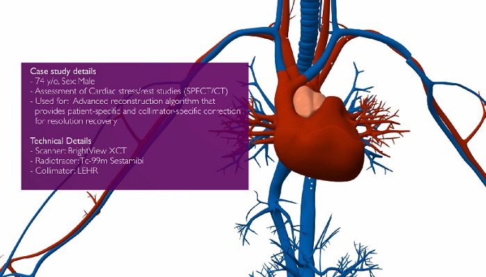 Algorithme de reconstruction avanc&eacute; SPECT